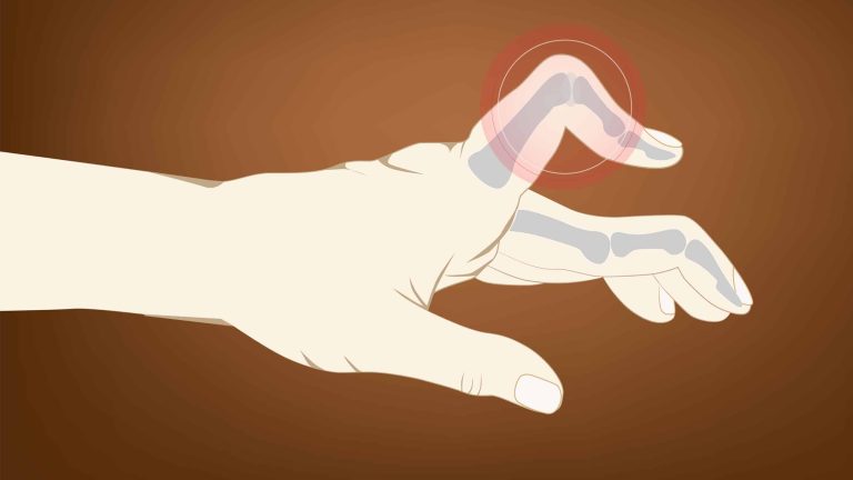 Fixing Your Firing Grip After an Injury